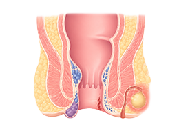 항문질환