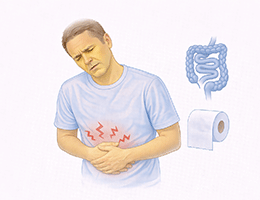 자극성 장 증후군