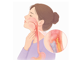 후두인두역류증
