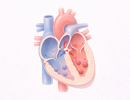 심방중격결손증