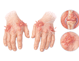 류마티스관절염